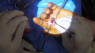 dedo en gatillo operacion
