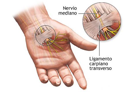 Imagen 1 Sindrome del Tunel Carpiano