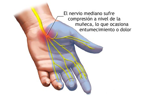 centro médico de la mano Imagen 2 Sindrome del Tunel Carpiano